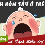 Các cách điều trị rôm sảy ở trẻ em cực hiệu quả bệnh rôm sảy ở trẻ em