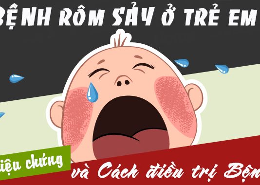 Các cách điều trị rôm sảy ở trẻ em cực hiệu quả bệnh rôm sảy ở trẻ em